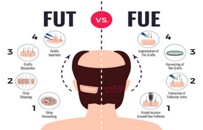 زراعة شعر اللحية 3 الفرق بين fue وطريقة fut
