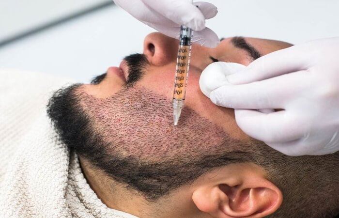زراعة شعر اللحية 2 زراعة الذقن