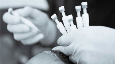 DHI Hair Transplant 3 dhi sac ekimi 1 1