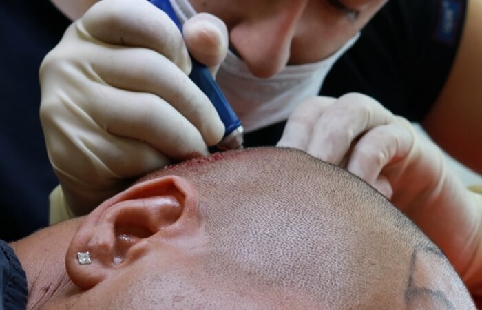 كيف يتم زراعة الشعر