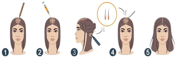 زراعة الشعر بدون حلاقة في تركيا 3 زراعة الشعر للنساء بدون حلاقة