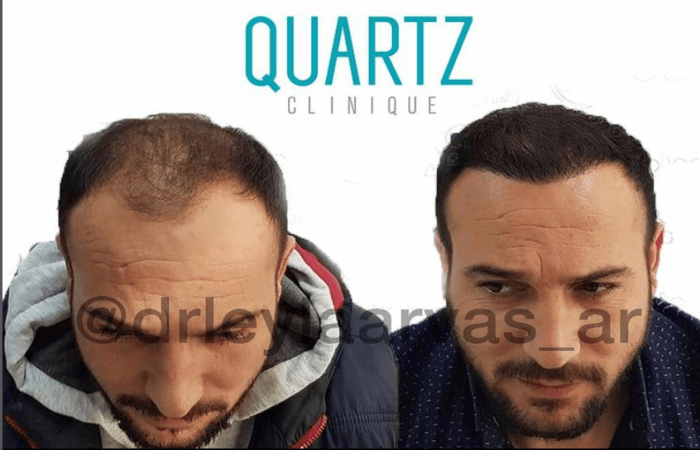 زراعة الشعر بطريقة الاقتطاف 6 راعة الشعر بطريقة الاقتطاف