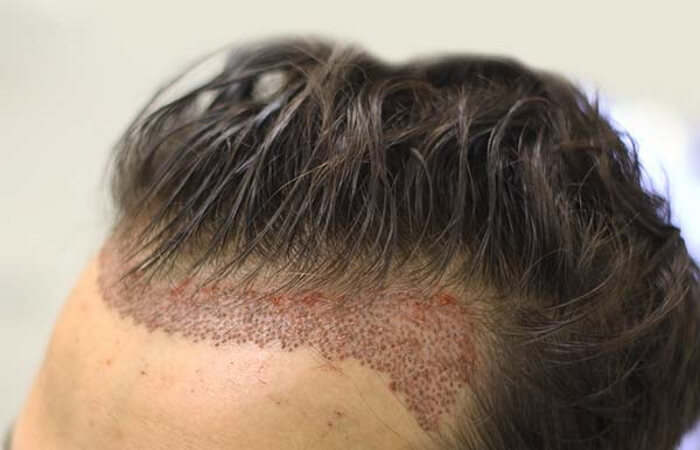 زراعة الشعر بدون حلاقة في تركيا