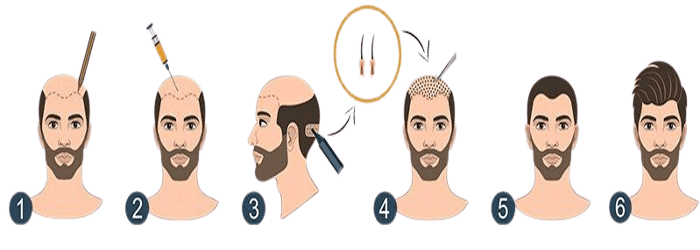 زراعة الشعر بدون حلاقة في تركيا