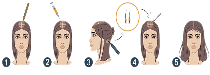 زراعة الشعر للنساء بدون حلاقة