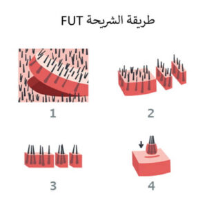 عملية زراعة الشعر للنساء 3 زراعة الجبهه للنساء
