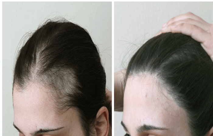عملية زراعة الشعر للنساء