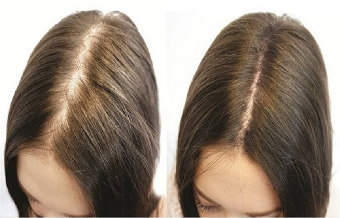 علاج الليزر للشعر 4 نتيجة علاج تساقط الشعر بالليزر