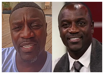 Celebrity Hair Transplant 2 Akon-hair-transplant