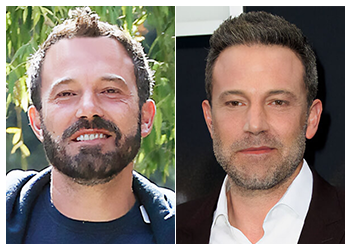 Ben Affleck hair transplant