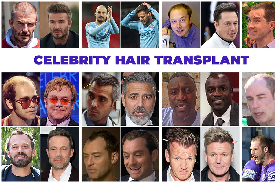 Celebrity Hair Transplant