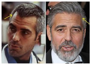 George-Clooney-hair-transplant