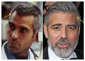 Celebrity Hair Transplant 10 George Clooney hair transplant