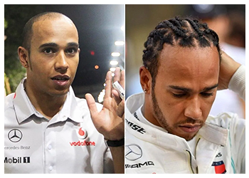 Lewis Hamilton Hair Transplant