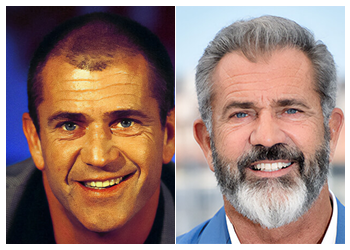 Mel gibson hair transplant