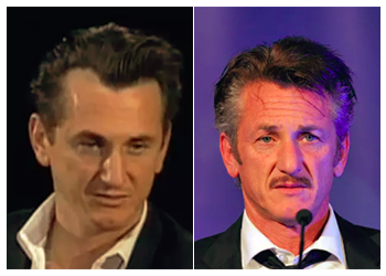 Sean Penn Hair Transplant