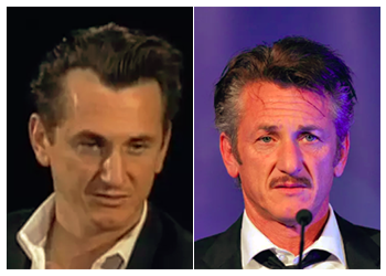 Celebrity Hair Transplant 20 Sean Penn Hair Transplant