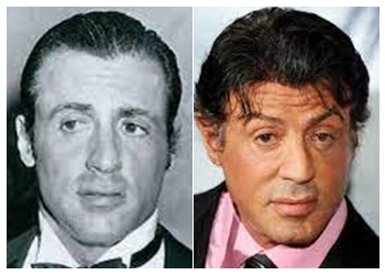 Sylvester Stallone hair transplant