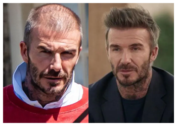 Celebrity Hair Transplant 4 david beckam hair transplant