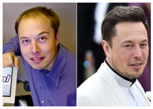 elon-musk-hair-transplant