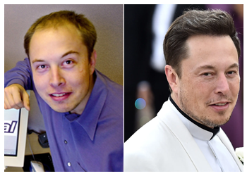 elon musk hair transplant