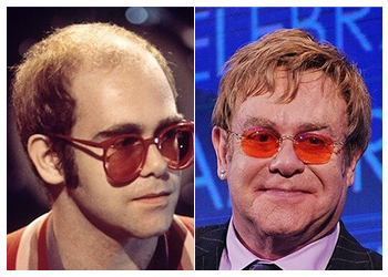 Celebrity Hair Transplant 9 elton john hair transplant