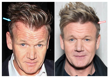 Celebrity Hair Transplant 7 gordon ramsey hair transplant