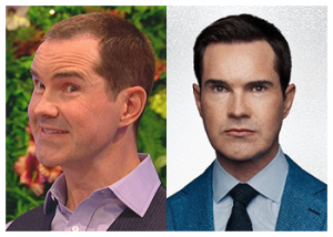 jimmy-carr-hair-transplant