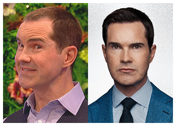 jimmy carr hair transplant