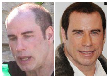 john travolta hair transplant