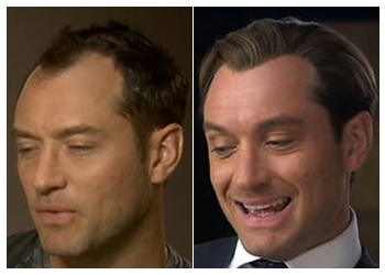 Celebrity Hair Transplant 8 jude law hair transplant