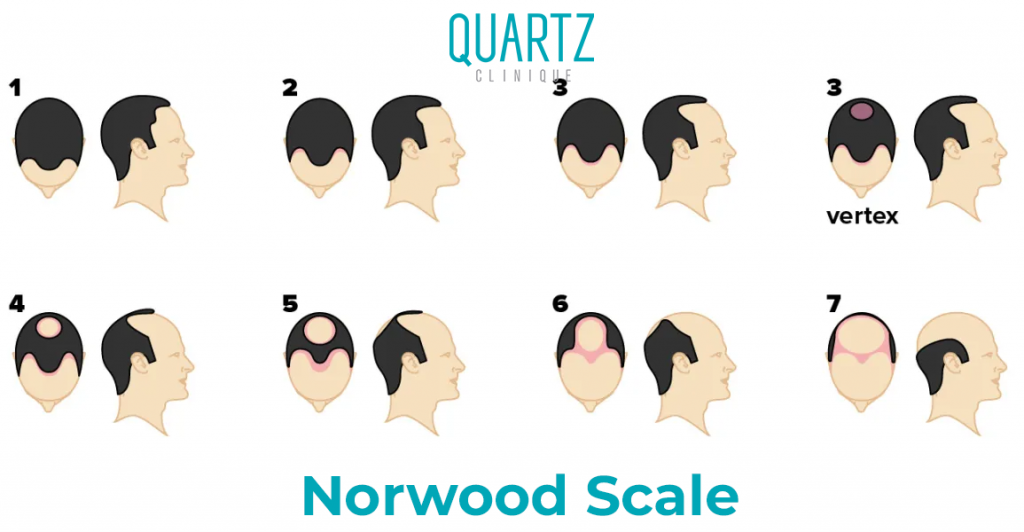 Norwood Scale 6-7 Hair Transplantation - Quartz Hair