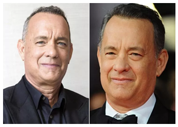 Celebrity Hair Transplant 12 tom hanks hair transplant