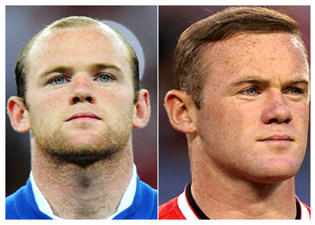 Celebrity Hair Transplant 15 wayne rooney