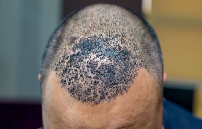 حكة الراس بعد زراعة الشعر 1 اسباب الحكة بعد زراعة الشعر وفشل الزراعة