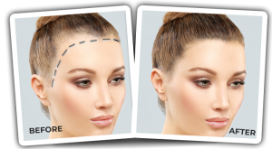 forehead hair transplant for women