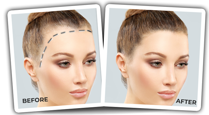 Forehead Reduction with Hair Transplantation in Women - Quartz Hair