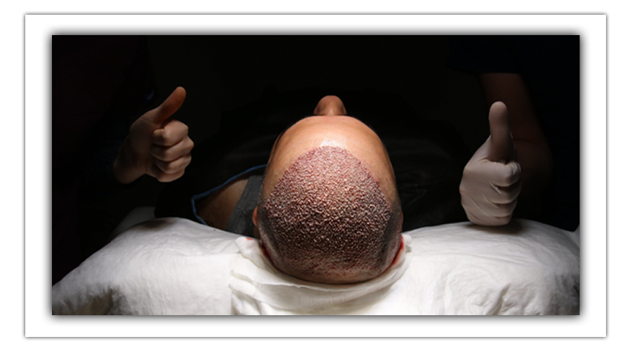 hair transplant