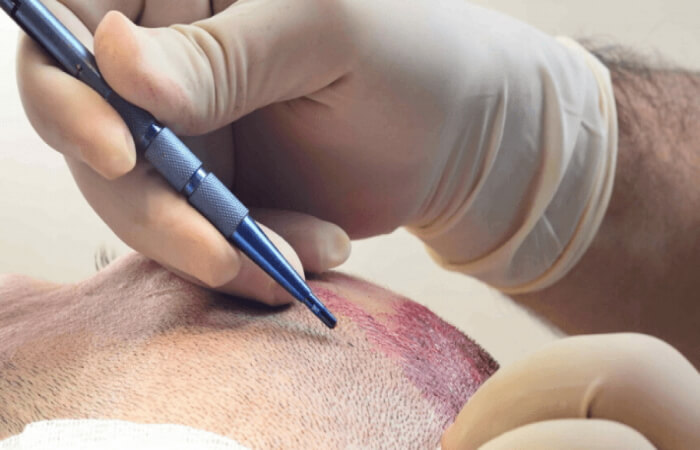 تقنية السفير لزراعة الشعر 2 تقنية السفير لزراعة الشعر