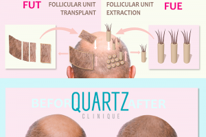 Follicular unit transplant (FUT)