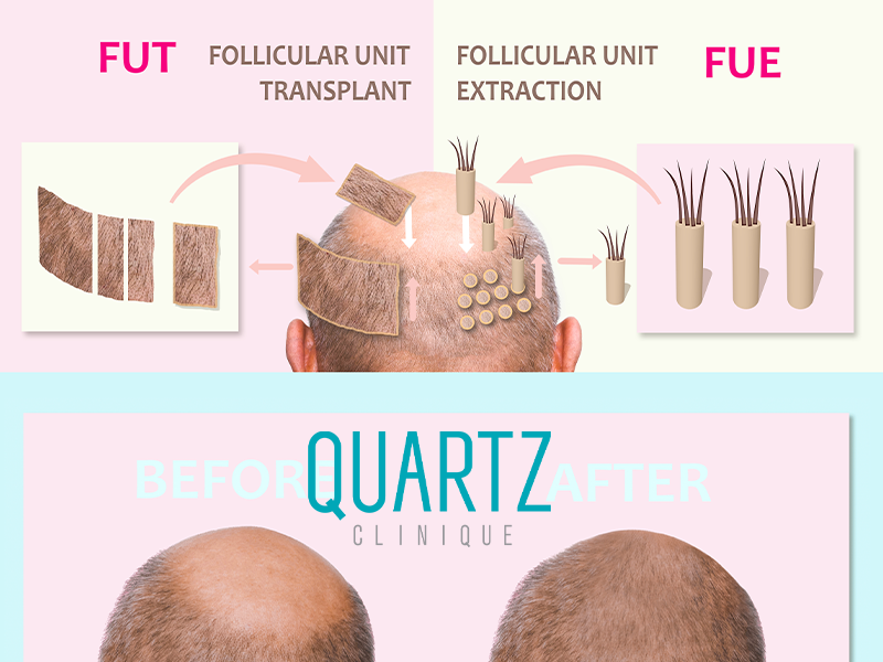 Follicular unit transplant (FUT) - Quartz Hair
