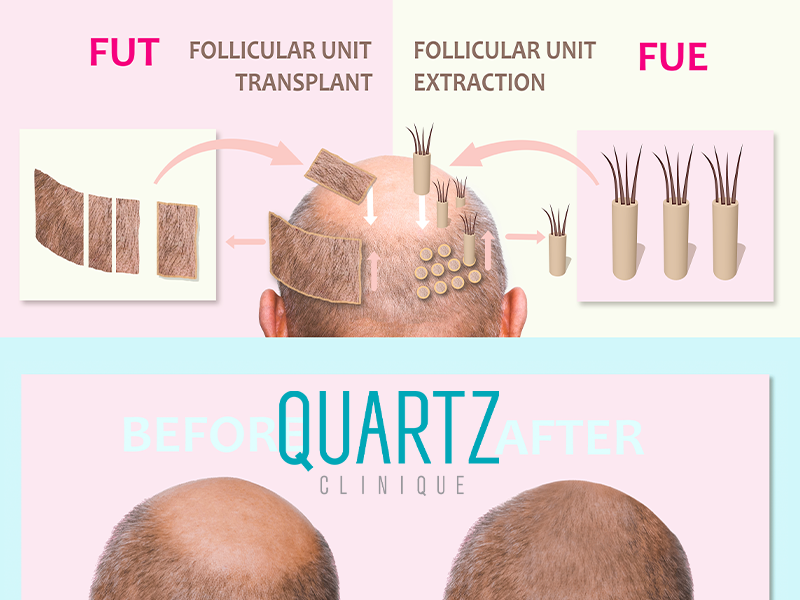 Follicular unit transplant (FUT)