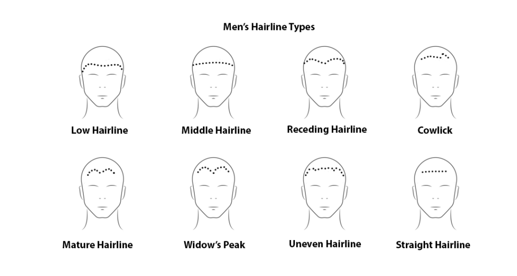Hair Restoration 5 men's hairline types