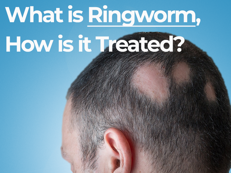 Symptoms and Causes of Ringworm of the scalp - VnRoyal
