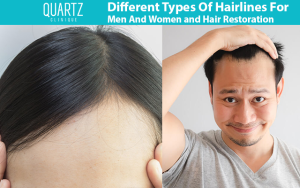 Different Types Of Hairlines For Men And Women and Hair Restoration