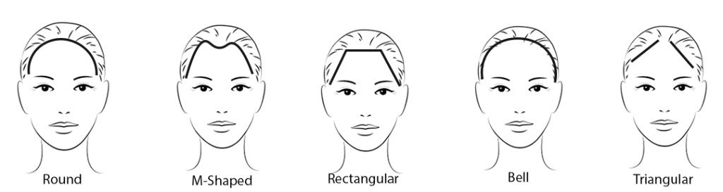 Hair Restoration 4 women hairline types
