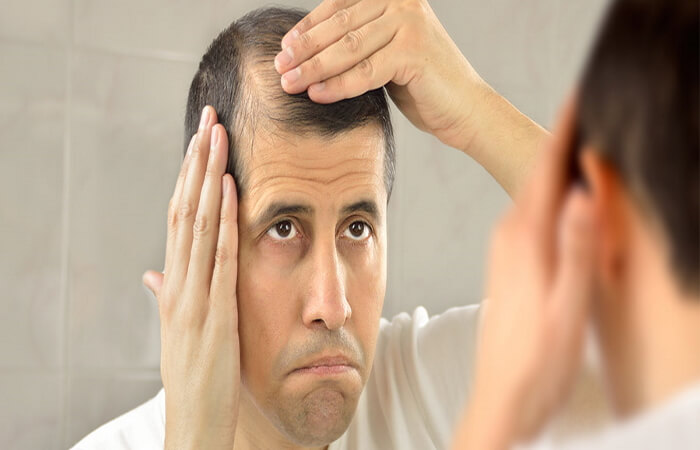 فشل زراعة الشعر