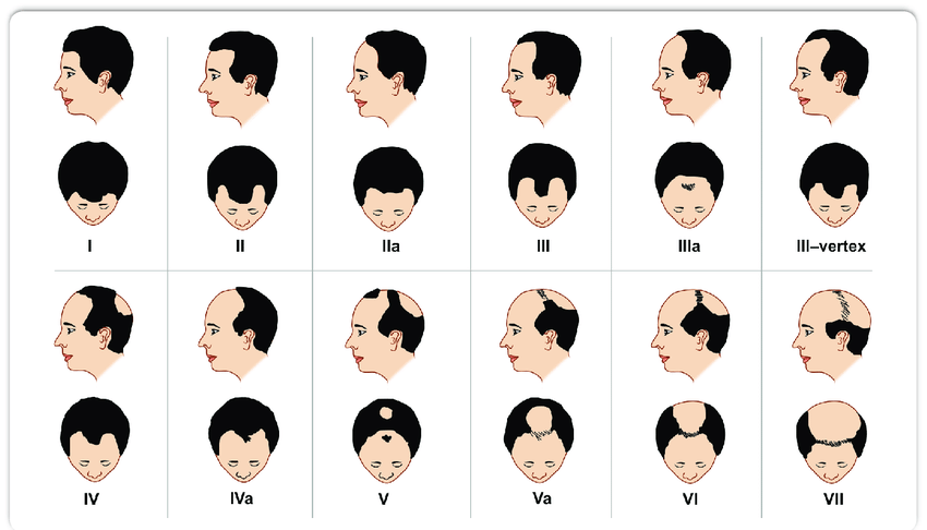 Crown Hair Transplant (Vertex Area) 5 Norwood Hamilton Scale
