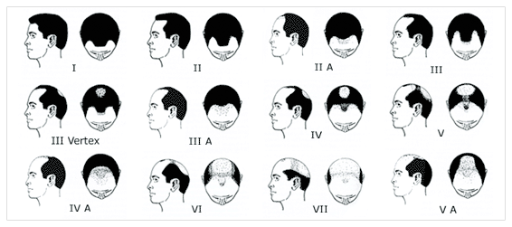 What Is My Norwood Hamilton scale