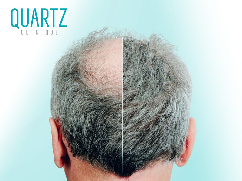 Crown Hair Transplant (Vertex Area) - Quartz Hair